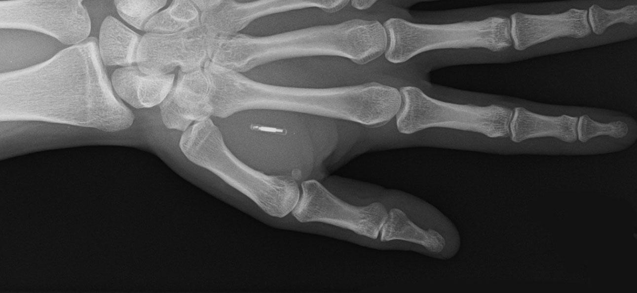 X-ray of a human hand with a small implanted chip visible between the finger bones